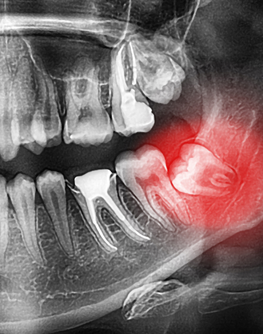 Les problèmes potentiels des dents de sagesse Les problèmes potentiels des dents de sagesse